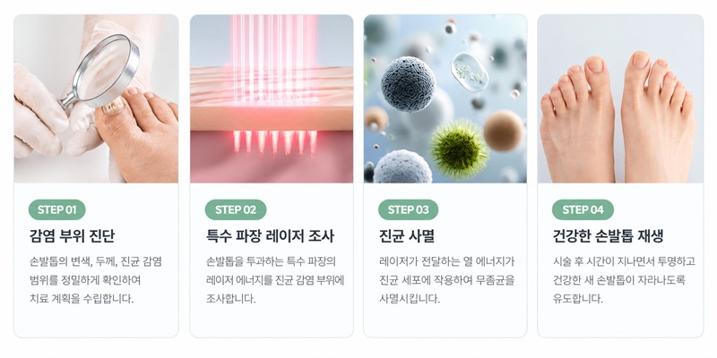 제주 무좀 치료하는 오니코레이저 시술 과정