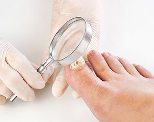 돋보기로 발톱 무좀 감염 부위를 정밀하게 진단하는 과정